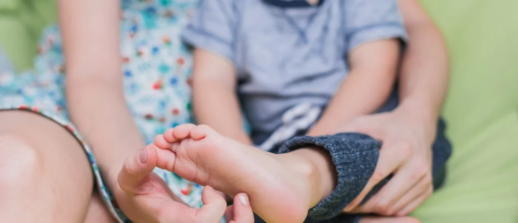 Ponseti Casting for Clubfoot