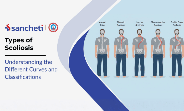 Types of scoliosis