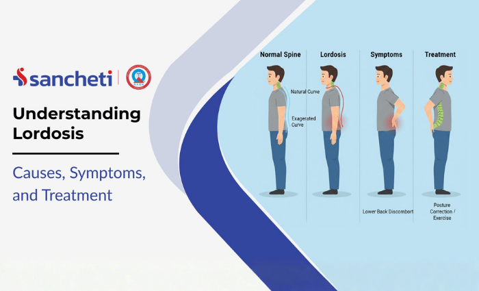 Lordosis Causes and symptoms