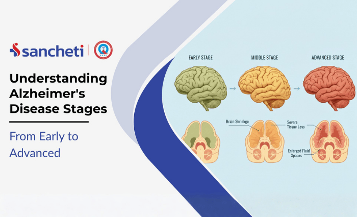 Understanding Alzheimer disease stages