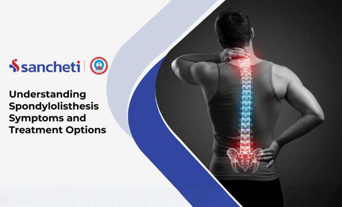 Spondylolisthesis symtoms and treatment