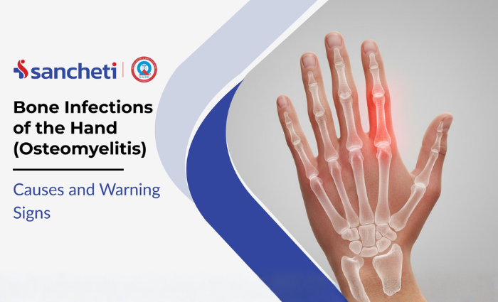 Bone Infections of the Hand (Osteomyelitis) Causes and Warning Signs