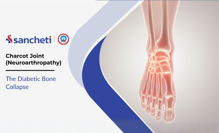 Charcot Joint (Neuroarthropathy): The Diabetic Bone Collapse 1 Charcot Joint (Neuroarthropathy) The Diabetic Bone Collapse