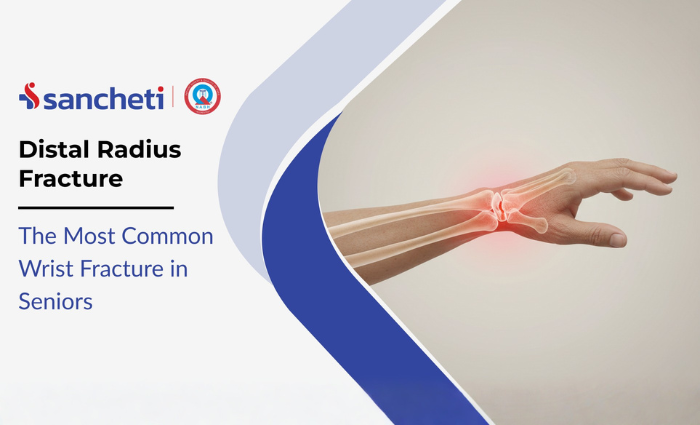 Distal Radius Fracture: The Most Common Wrist Fracture in Seniors 1 Distal Radius Fracture The Most Common Wrist Fracture in Seniors