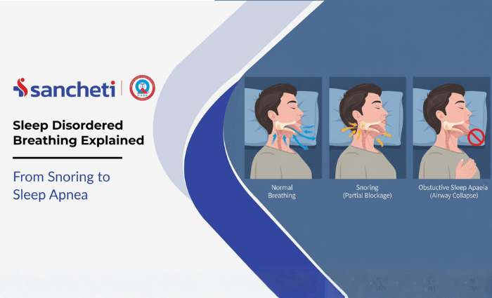 Sleep Disordered Breathing Explained From Snoring to Sleep Apnea
