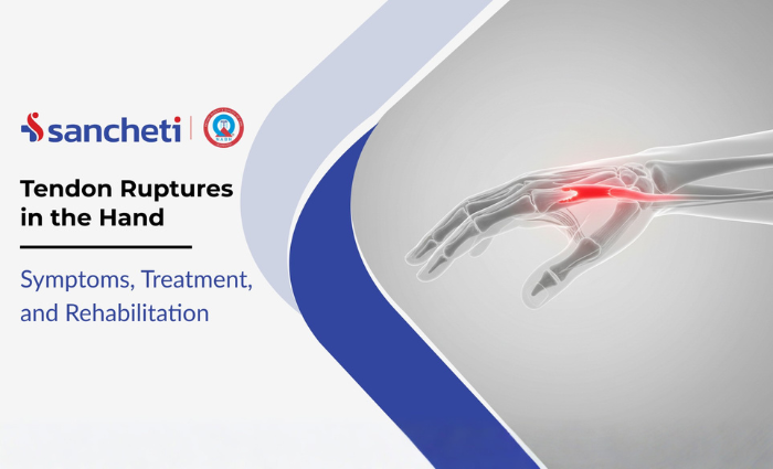 Tendon Ruptures in the Hand Symptoms, Treatment, and Rehabilitation