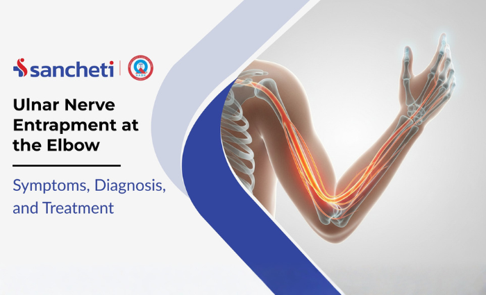 Ulnar Nerve Entrapment at the Elbow Symptoms, Diagnosis, and Treatment