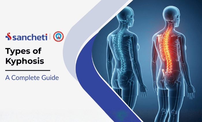 types of Kyphosis