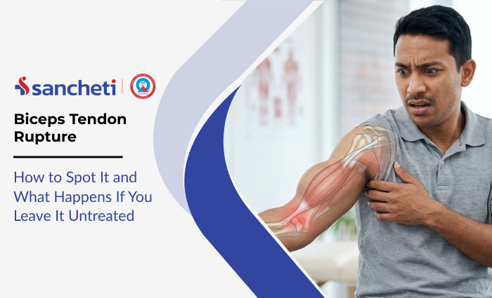 Biceps Tendon Rupture: How to Spot It and What Happens If You Leave It Untreated 5 Biceps Tendon Rupture