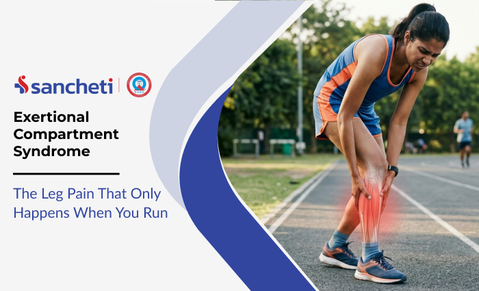 Exertional Compartment Syndrome: The Leg Pain That Only Happens When You Run 7 Exertional Compartment Syndrome