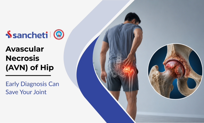 Avascular Necrosis (AVN) of Hip: Early Diagnosis Can Save Your Joint 9 avascular_necrosis_avn_of_hip_early_diagnosis_can_save_your_joint