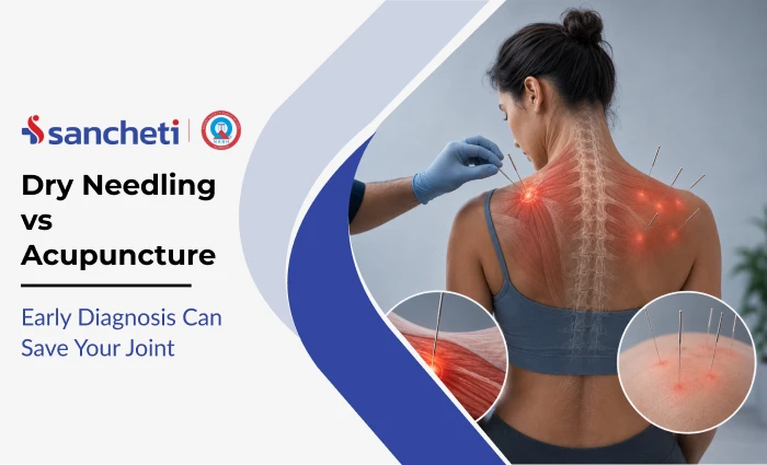 dry_needling_vs_acupuncture_1x
