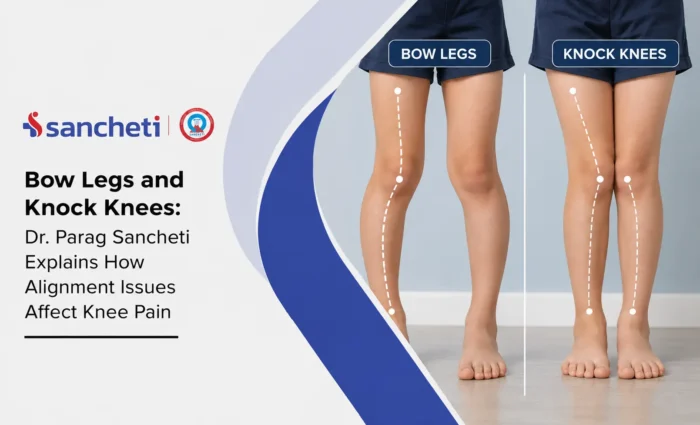 Bow Legs and Knock Knees Dr. Parag Sancheti Explains How Alignment Issues Affect Knee Pain